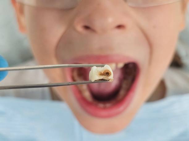 Best Emergency Tooth Extraction in Julesburg, CO